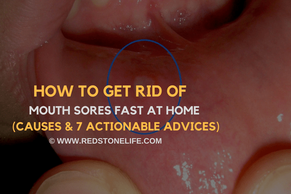 how-to-get-rid-of-mouth-sores-fast-at-home-7-actionable-hacks